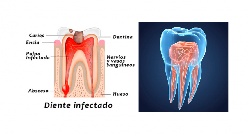 Endodoncia: Tratamiento que puede salvar nuestro diente o muela ...